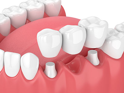 Dental Implants in Glendale